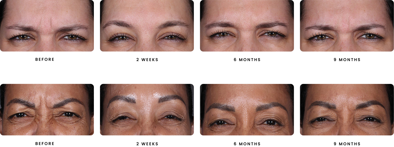 frown lines treatment with daxxify